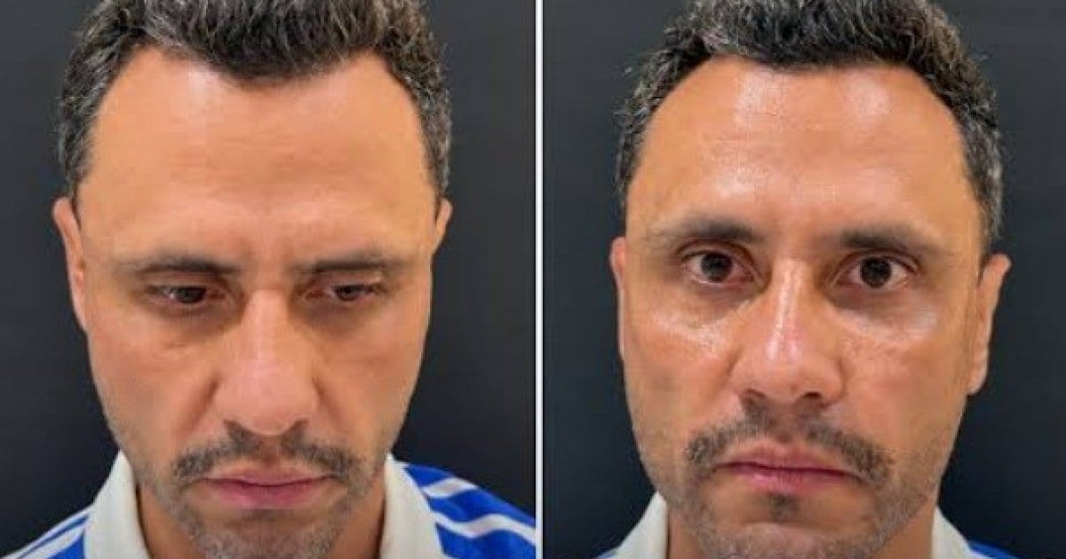 Cleitinho Azevedo realiza harmonização facial após ser eleito governador de Minas Gerais