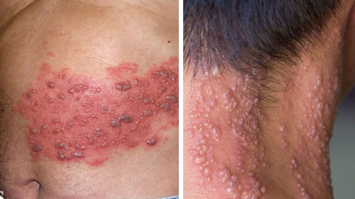 Senado aprova na CAS vacinação gratuita contra herpes zoster para maiores de 50 anos