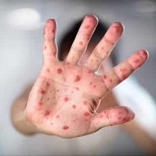 Por que milhões de pessoas em todo mundo vão contrair sarampo em 2026