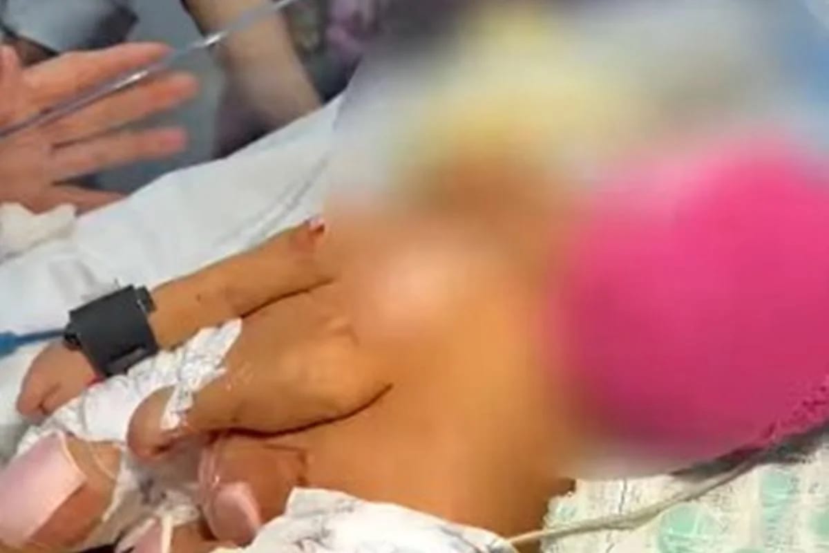Gêmeas siamesas nascem no Hmib e família avalia cirurgia de separação