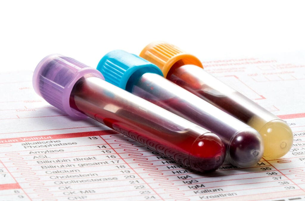 Anvisa Registra Primeiro Exame de Sangue para Alzheimer no Brasil