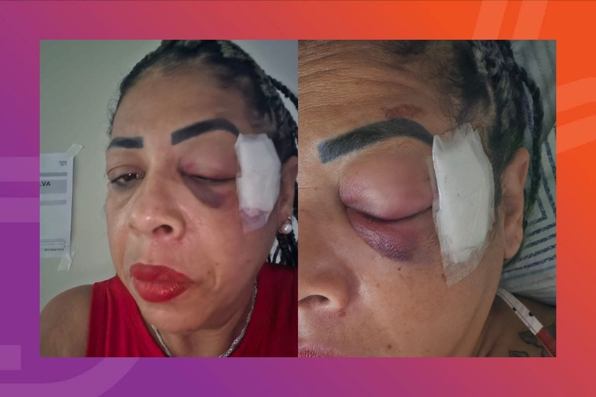 Servidora pública tem fraturas na face após ser atropelada em comemoração à vitória de Lula em Cáceres